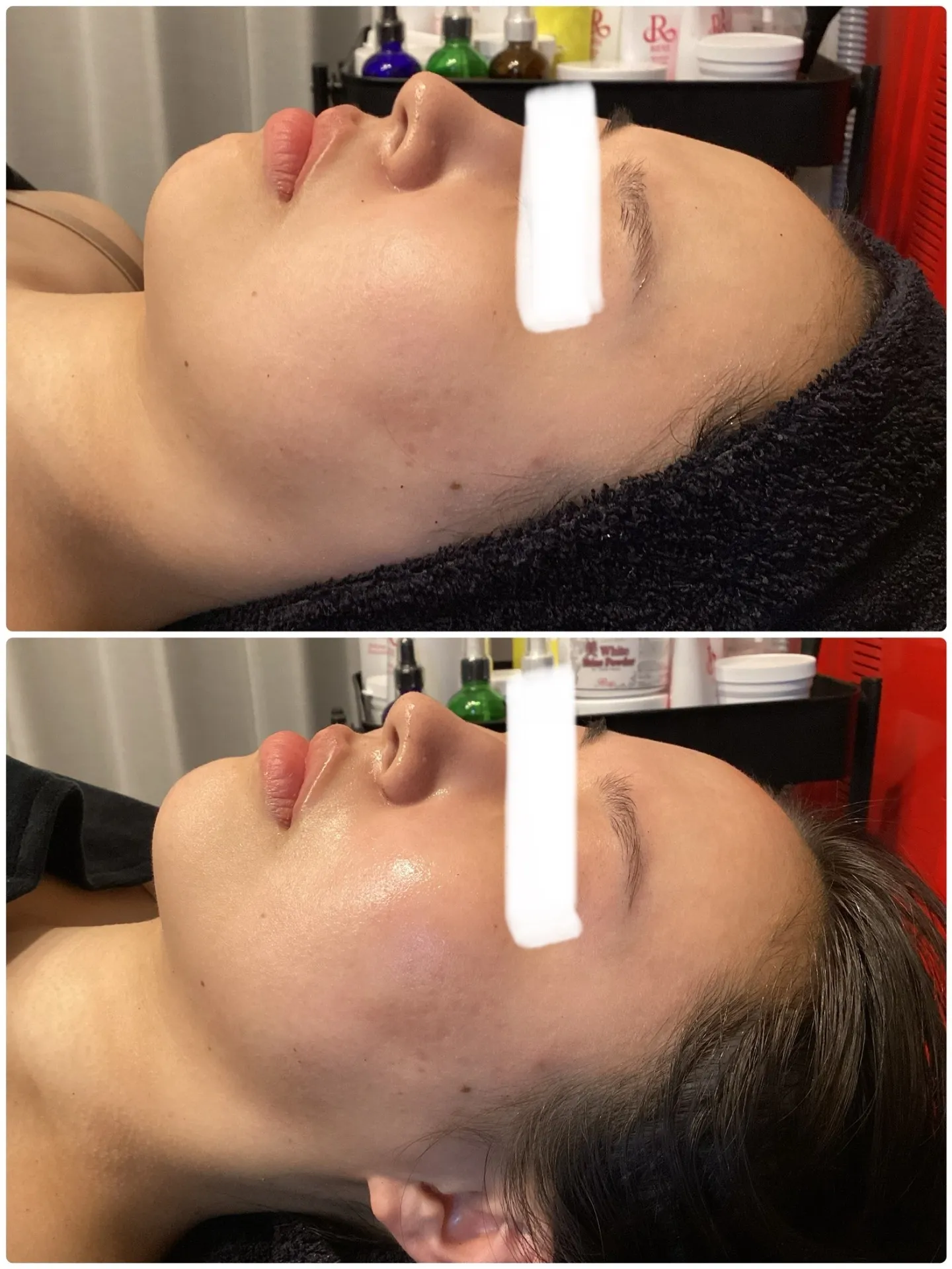 ハーブピーリング一度の変化