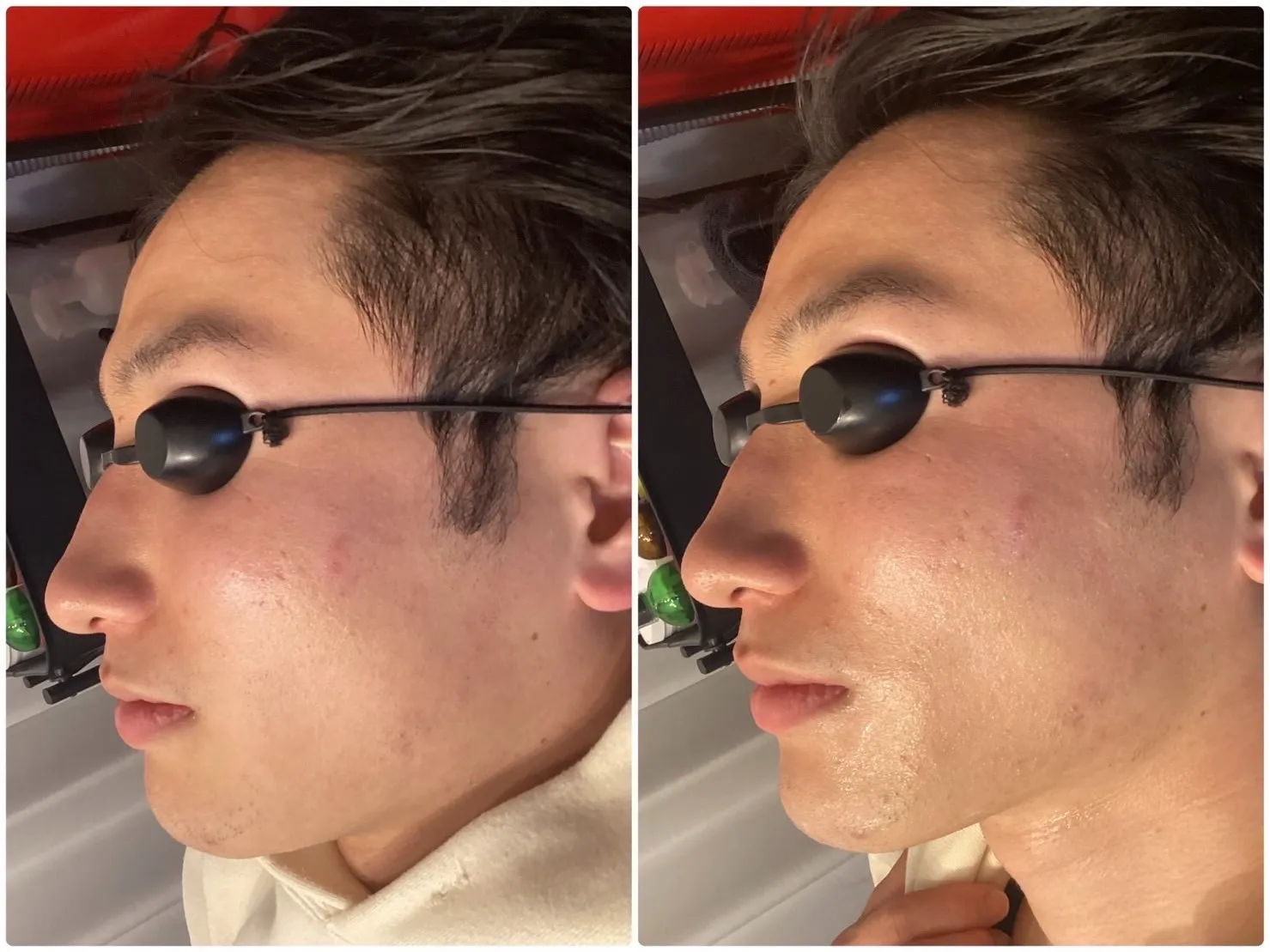 REVI光フォト1度の変化