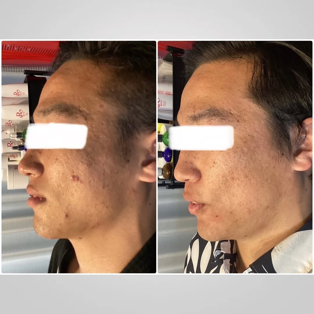 REVI陶肌トリートメントの効果が凄い！（ハーブピーリング）