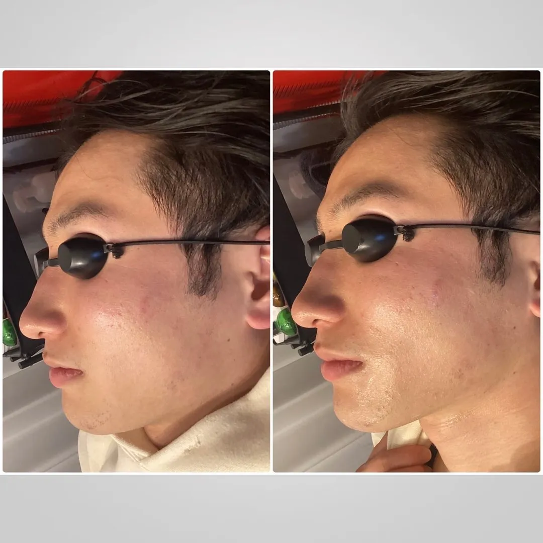 REVI脱毛器がハイスペックすぎる！驚きのビフォーアフター！