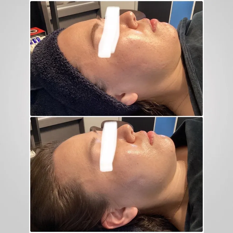 REVI（ルヴィ）陶肌トリートメントビフォーアフターが凄い！...