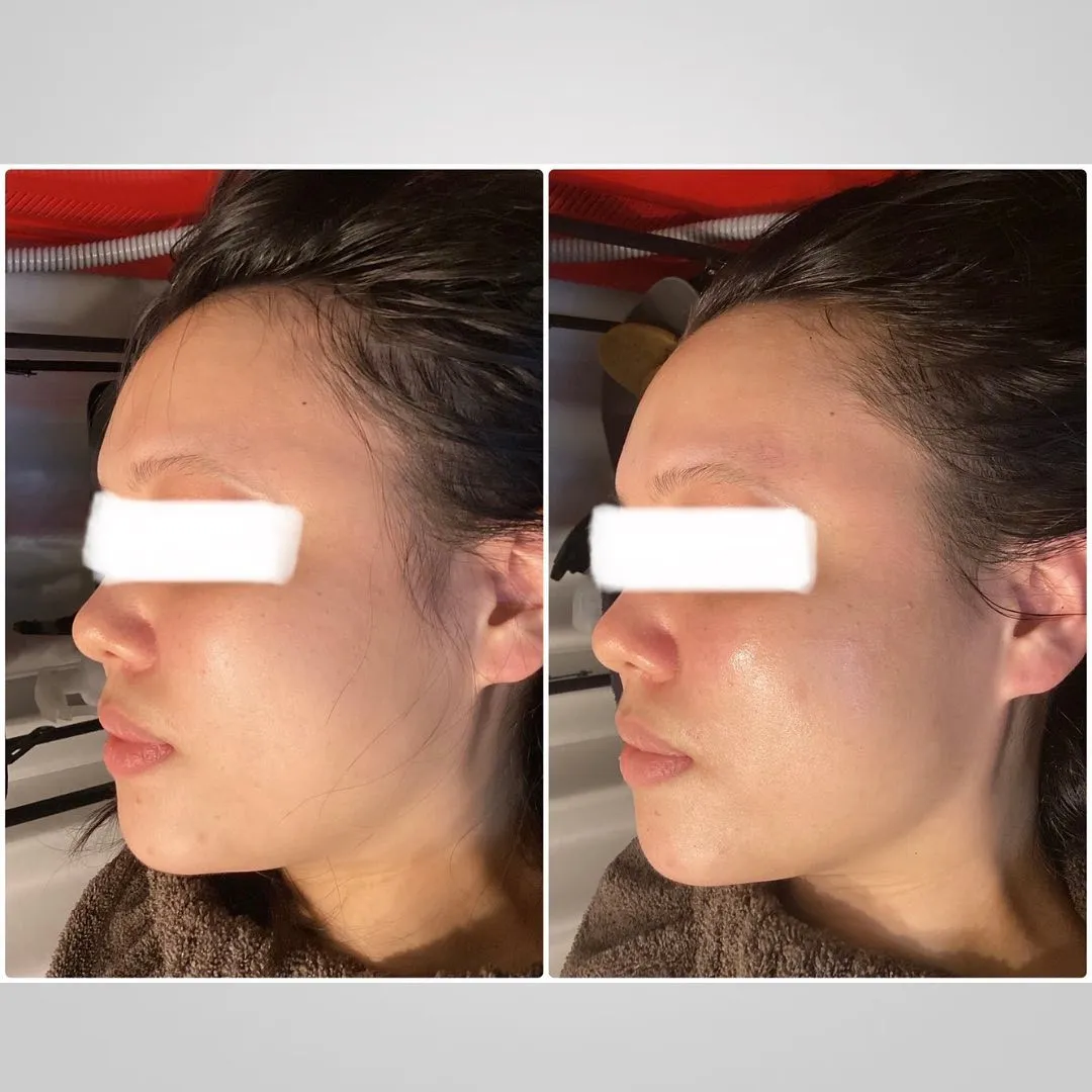 REVIハーブピーリングの一回の効果が凄い！