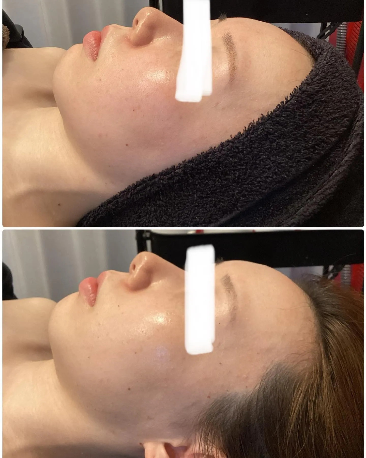 剥離なしハーブピーリングの効果が凄い！