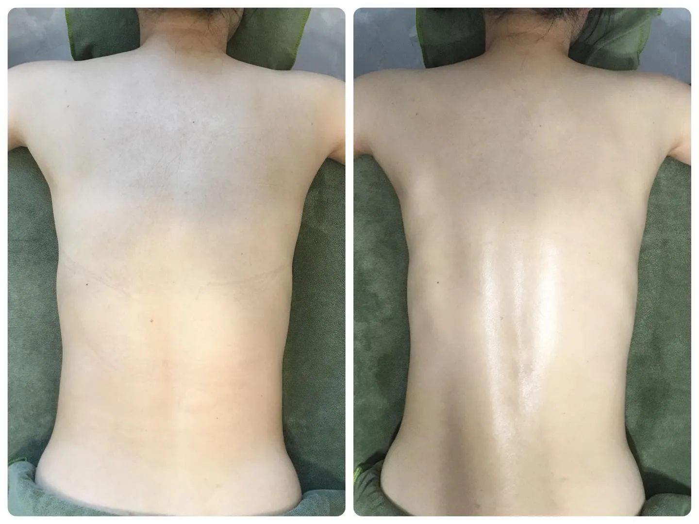 【衝撃】背中のハーブピーリングの結果が凄すぎる！