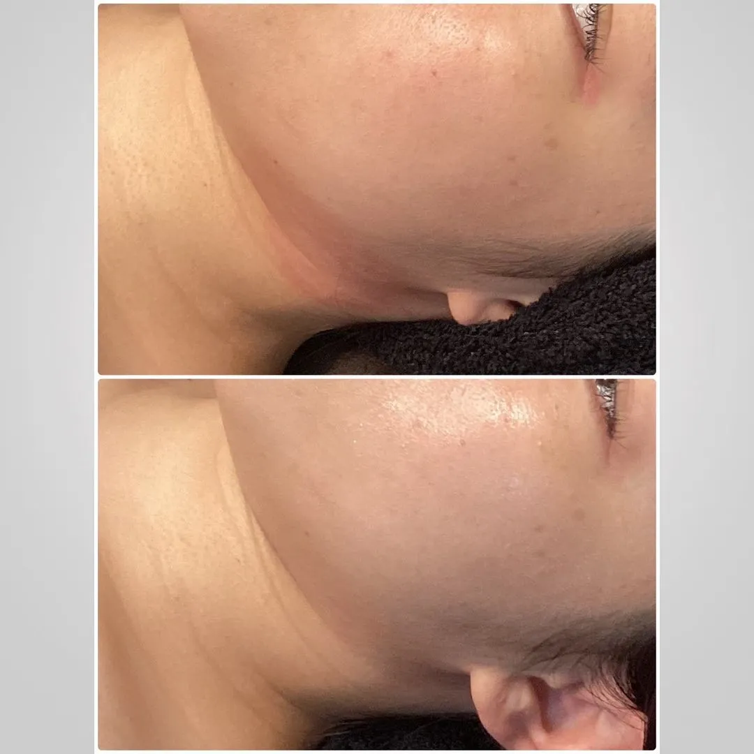 赤み改善にはREVIハーブピーリング！（商材）