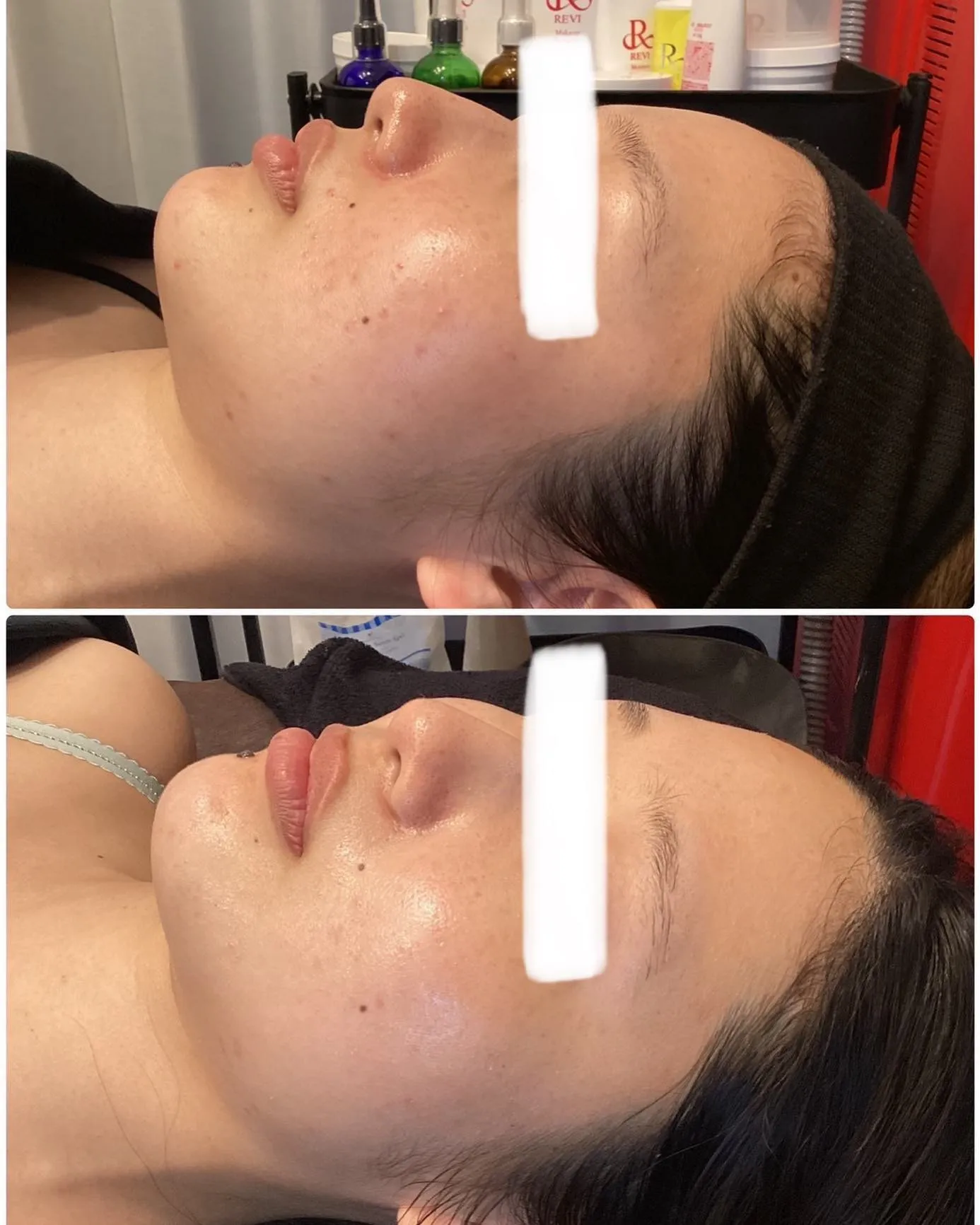 REVI陶肌トリートメントの効果が凄い！！（商材）