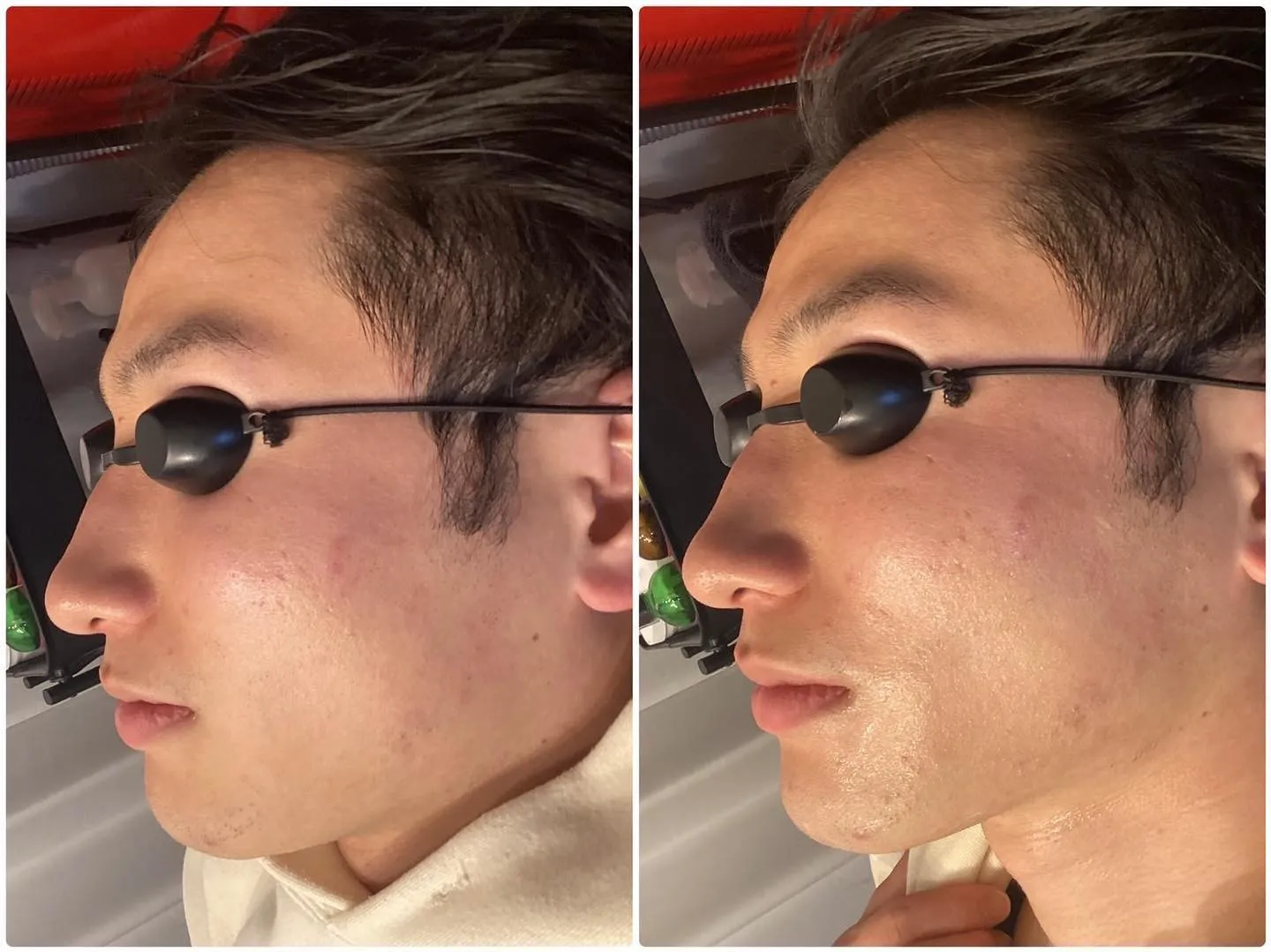 REVI脱毛器の光フォトの効果が凄い！