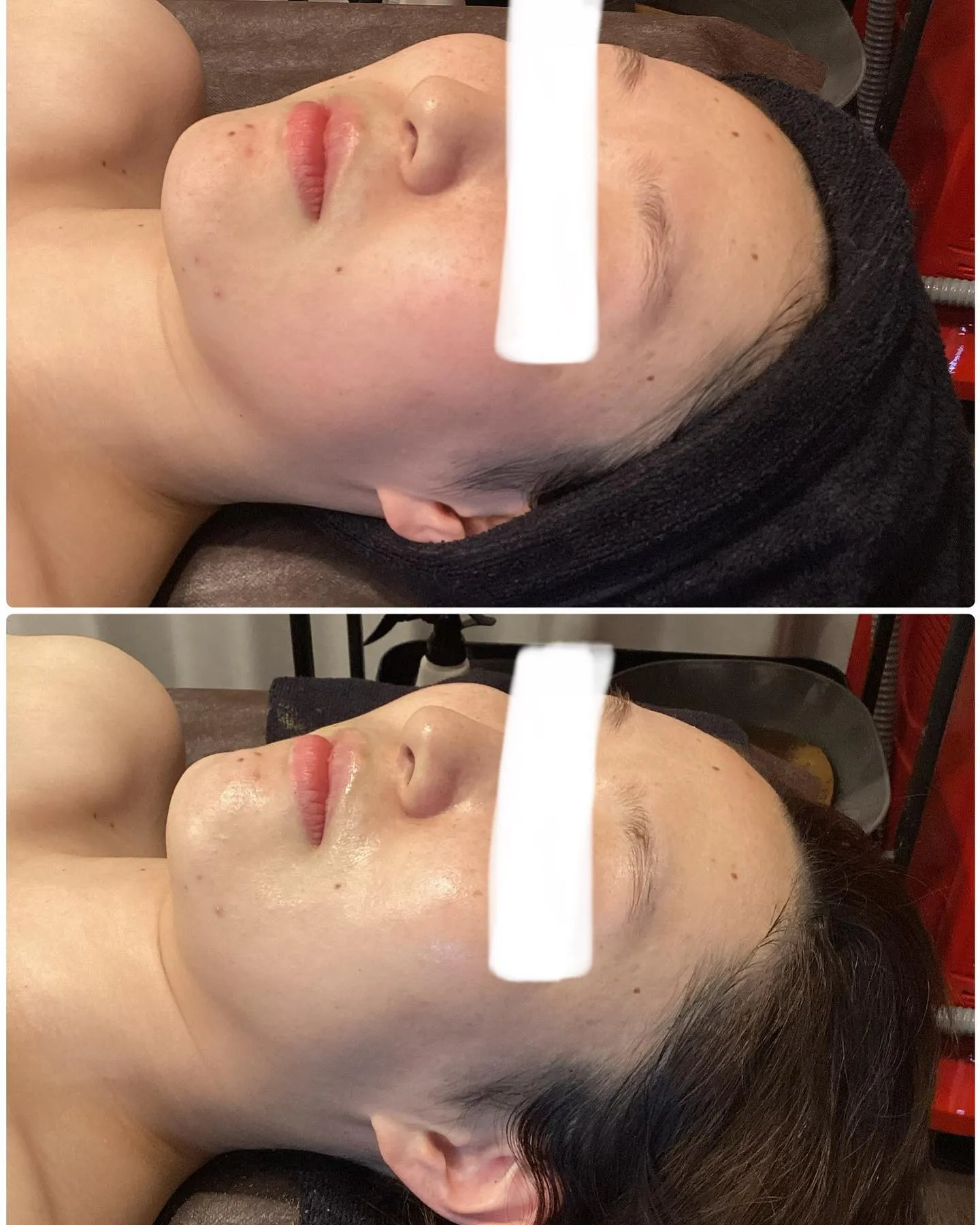 REVI陶肌トリートメント施術の効果