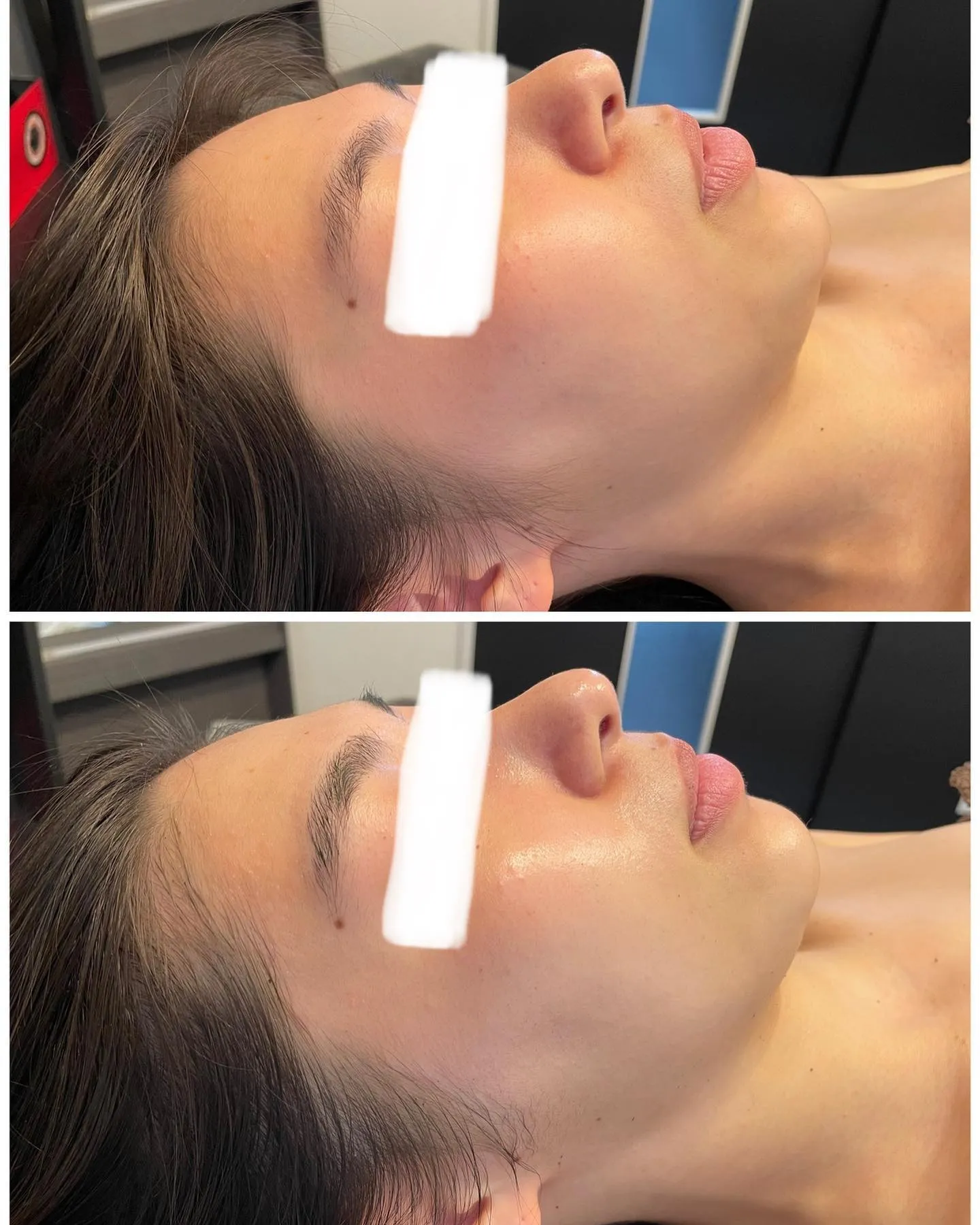 REVI陶肌トリートメントのビフォーアフター！導入受付中！