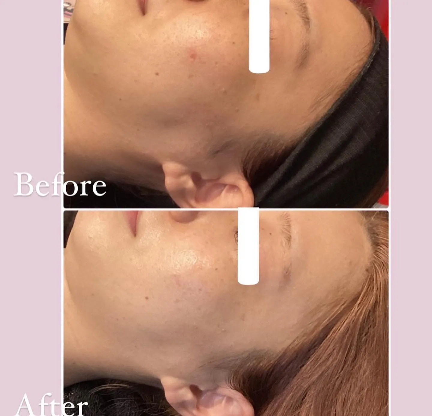 revi陶肌トリートメントオプション紹介！シルクパウダーで美...