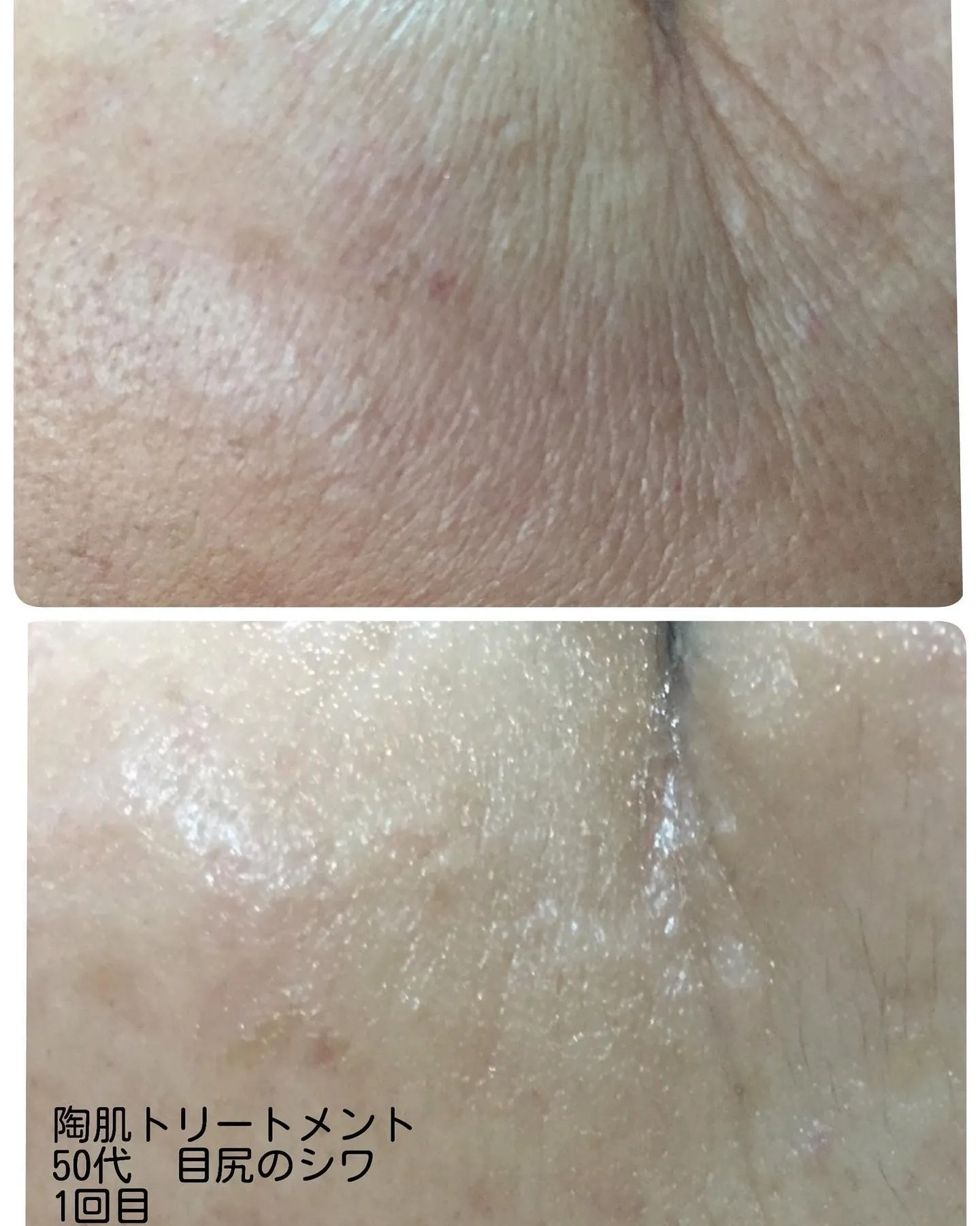 revi陶肌トリートメントオプション紹介！パワーローズブース...